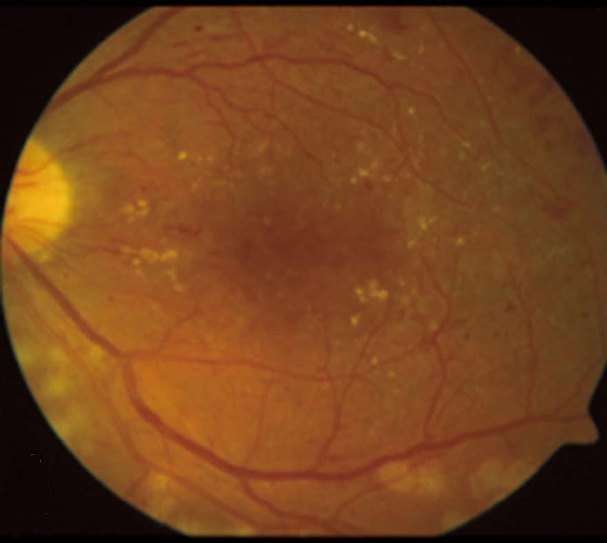 with improvement in visual acuity and macular thickness in