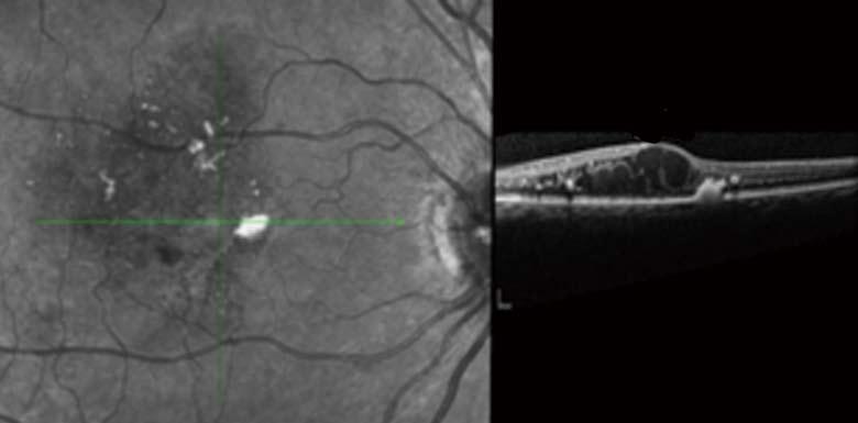 A: Fundus photo demonstrating classic presentation of diabetic macular edema with lipid exudate (yellow arrows), retinal thickening (black arrow), and intraretinal hemorrhages (red arrow); B, C: