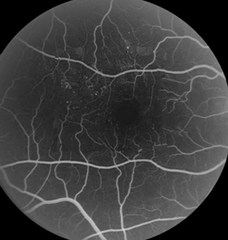 In 2002, a National Eye Institute-sponsored collaborative network, the Diabetic Retinopathy Clinical Research Network (DRCR.net), compared steroid versus laser treatment for DME [5].