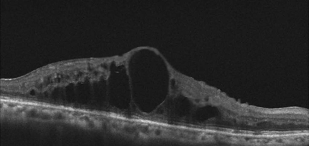 inner and outer retinal cysts (white arrows) with complete loss of the foveal contour (left) which does not respond despite repeated treatment with ranibizumab (right).