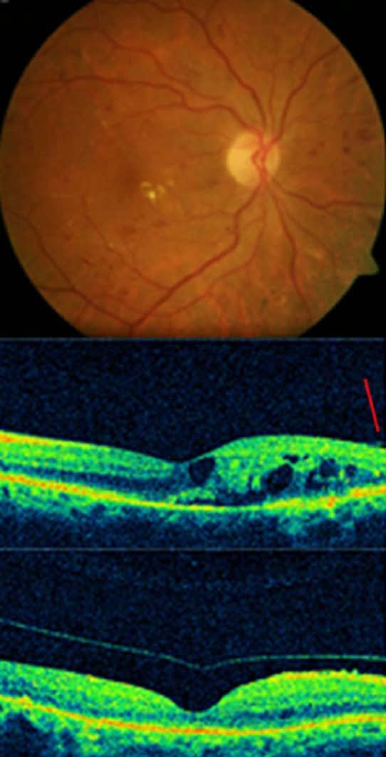 Diaz-Llopis M et al. Enzymatic vitrectomy for DR and DME Figure 1 Complete posterior vitreous detachment and complete resolution of macular edema in a diabetic patient treated with autologous plasmin.