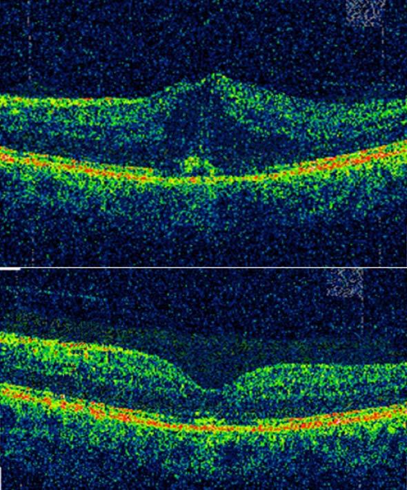 A B Figure 3 Regression of the new vessels of the optic disc in a treated eye with plasmin.