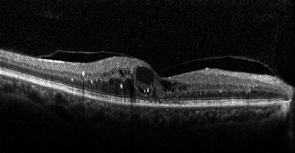 diabetic macular edema in the right eye. Four months following treatment, the macular edema almost completely resolved (B). The Snellen visual acuity improved from 20/200 to 20/60.