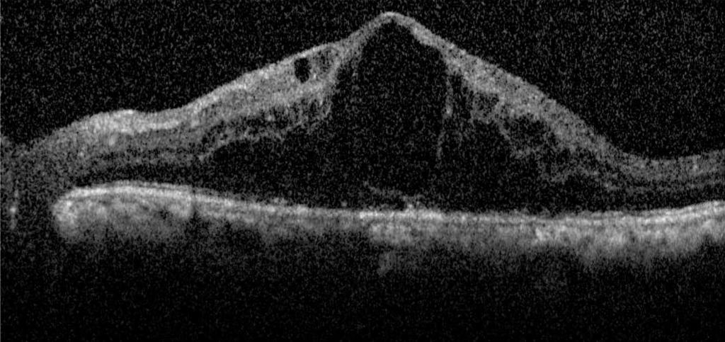 diabetic macular edema. Note extensive cystoid macular edema in both eyes (A and B) and subretinal fluid in the right (A).