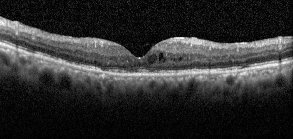 The Snellen visual acuity improved from 20/125 to 20/70 in the right eye, but did not change significantly in the left, likely due to atrophic changes in the outer retina as seen on optical coherence