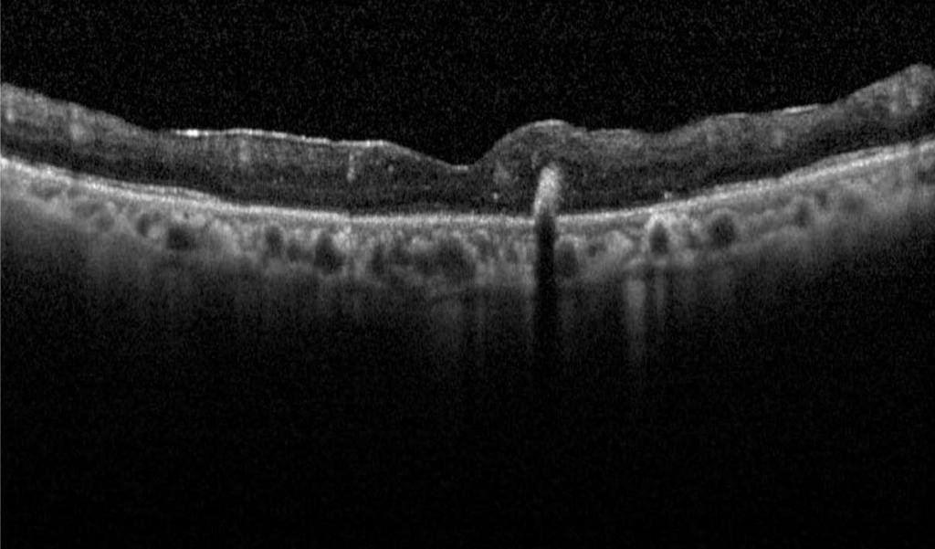 Note the focal vitreomacular adhesion with associated cystoid macular edema and intraretinal hard exudates.