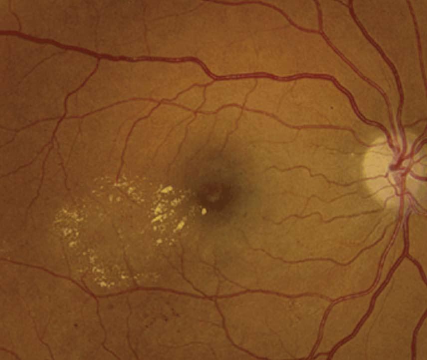 Stefanini FR et al. Bevacizumab for the management of diabetic macular edema age from microaneurysms and dilated retinal capillaries with abnormal permeability.