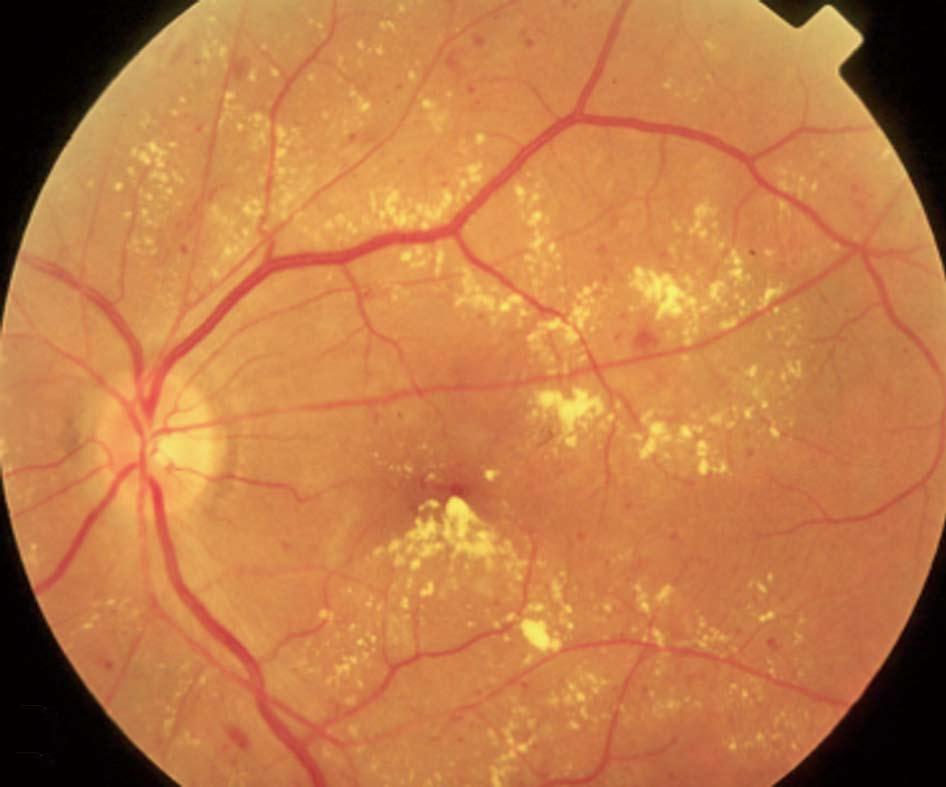 In diffuse macular edema, generalized leakage from dilated capillaries is observed throughout the posterior pole (Figure 2B).