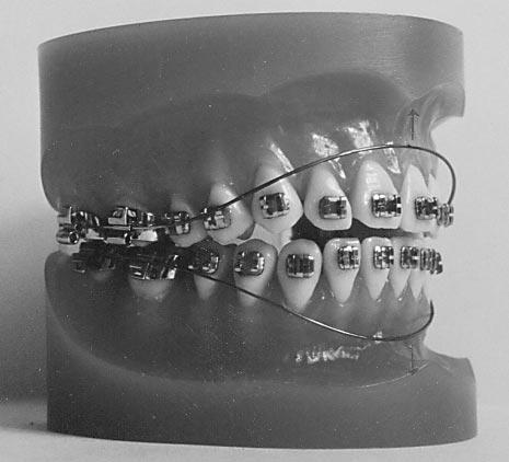 556 Küçükkeleș et al American Journal of Orthodontics and Dentofacial Orthopedics November 1999 A B Fig 1.