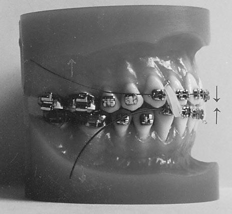 Skeletal relationship in the sagittal direction was Class I, and the dental relationship was Class I or mild Class II. Treatment Procedure After the placement of bands and 0.