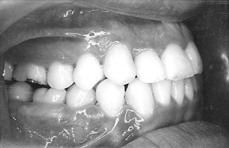 Elastics, which were applied to prevent incisor intrusion as a result of NiTi arch wires, caused extrusion and uprighting of the incisors. The 3.