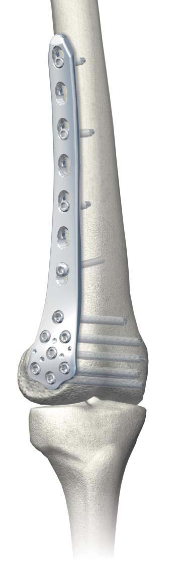LCP Distal Femur Plates Plates The LCP Distal Femur Plates are based on the LCP System. The shaft ption of the plate features Combi holes and the head features threaded holes.