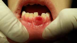 Most of the affected patients are the adults, in their fourth to sixth decade of life, whereas a few cases have been reported to occur in children, which involved more aggressive lesions,.