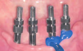 Extremely high hardness Honigum-Heavy exhibits easy cutting characteristics for providing pressure relief channels in corrective treatments.