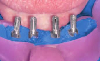 Especially for implant impressions Honigum-Heavy exhibits good fixation and torsion-preventing characteristics.