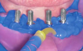 For implant treatments Honigum-Heavy should be used as a mono-phase impression material. Syringing impression posts with Honigum-Heavy.