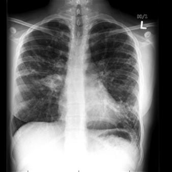 Treating Pulmonary Exacerbations How do we treat pulmonary exacerbations? Which antibiotics? How long do we treat?