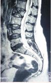 Ruptured disc - each vertebra in our spine is cushioned by a disc. If the disc ruptures there will be more pressure on a nerve, resulting in back pain.