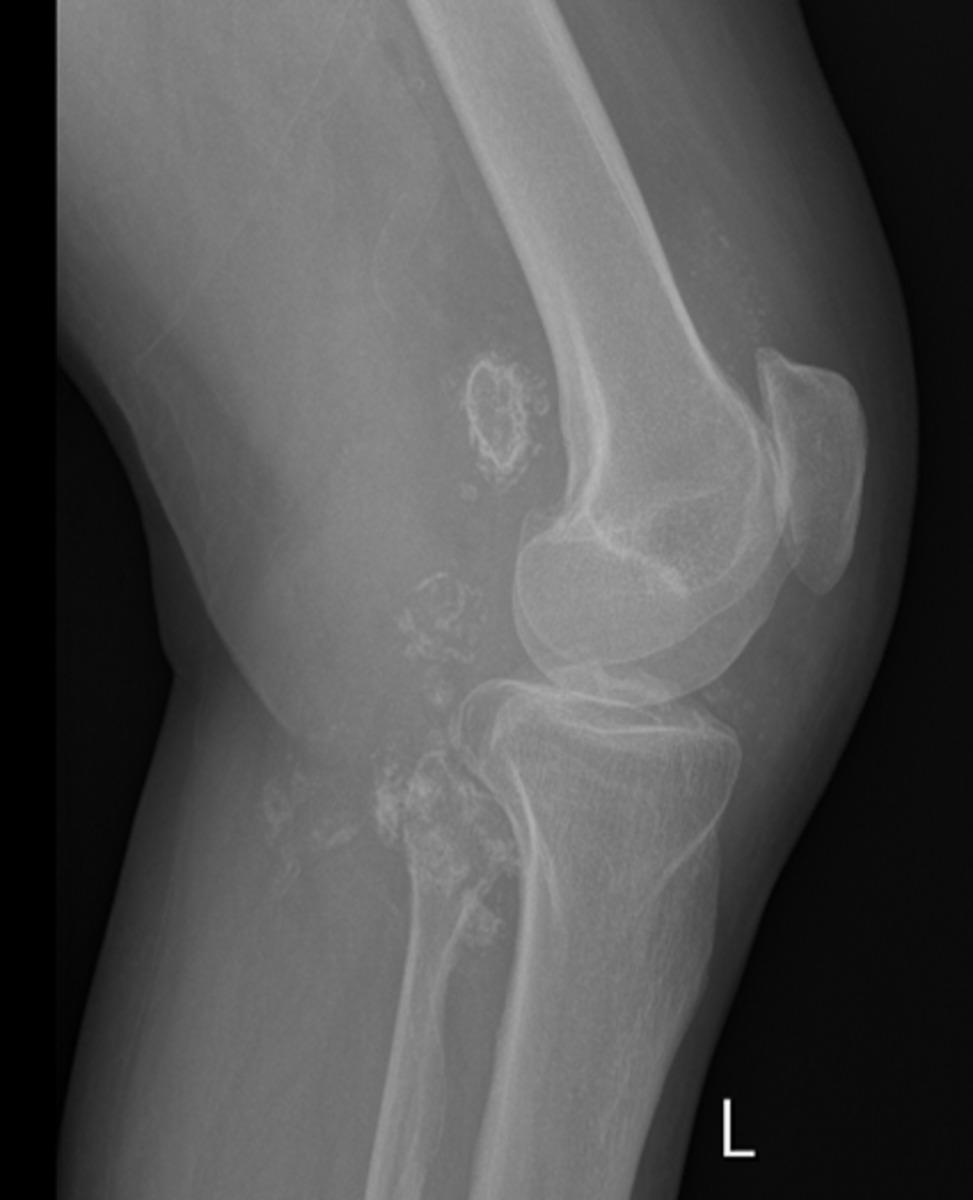 Fig. 7: x ray knee showing calcified