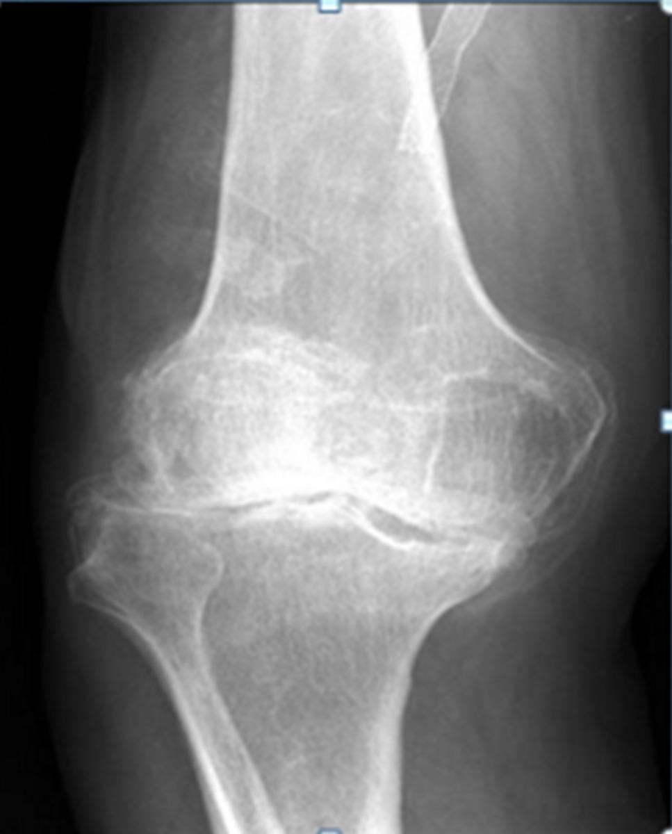 Fig. 10: x ray knee of a patient