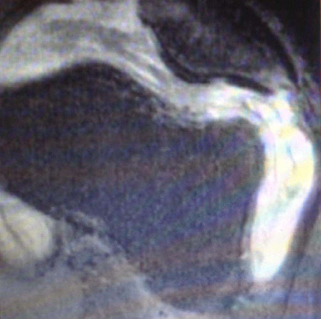 Fig. 11: Axial FS PD FSE showing synovial thickening and
