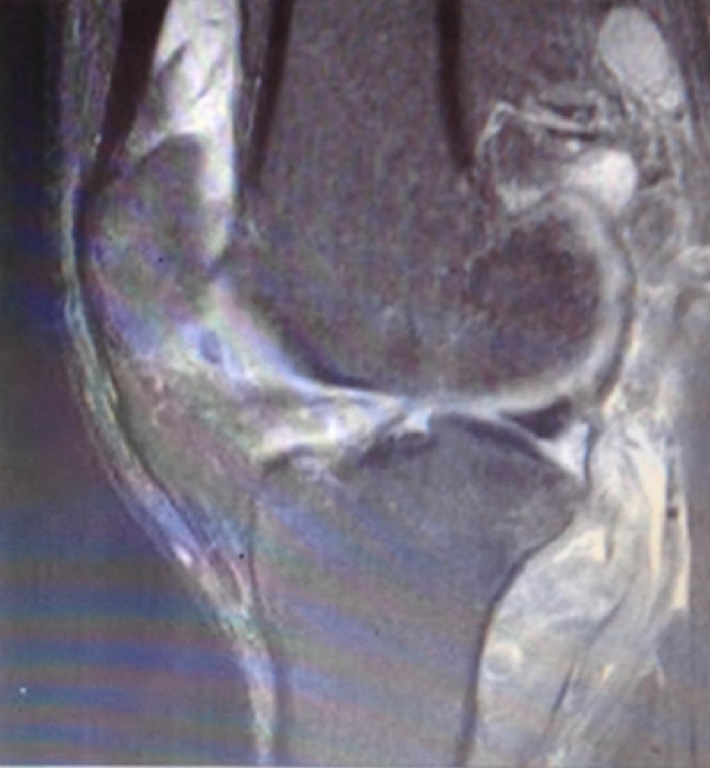 Fig. 12: Sagittal section showing synovial