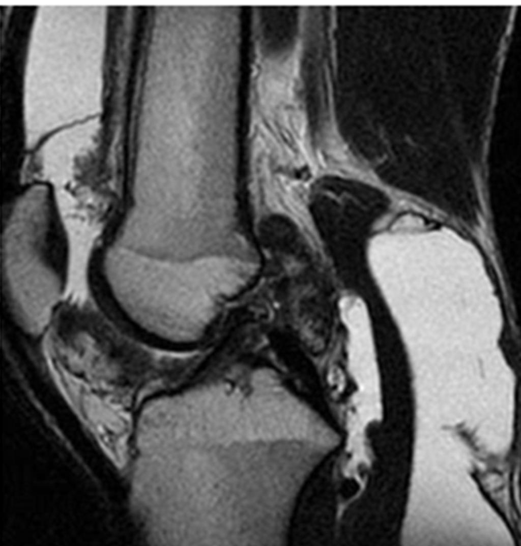 Fig. 2: Sagittal MRI image showing