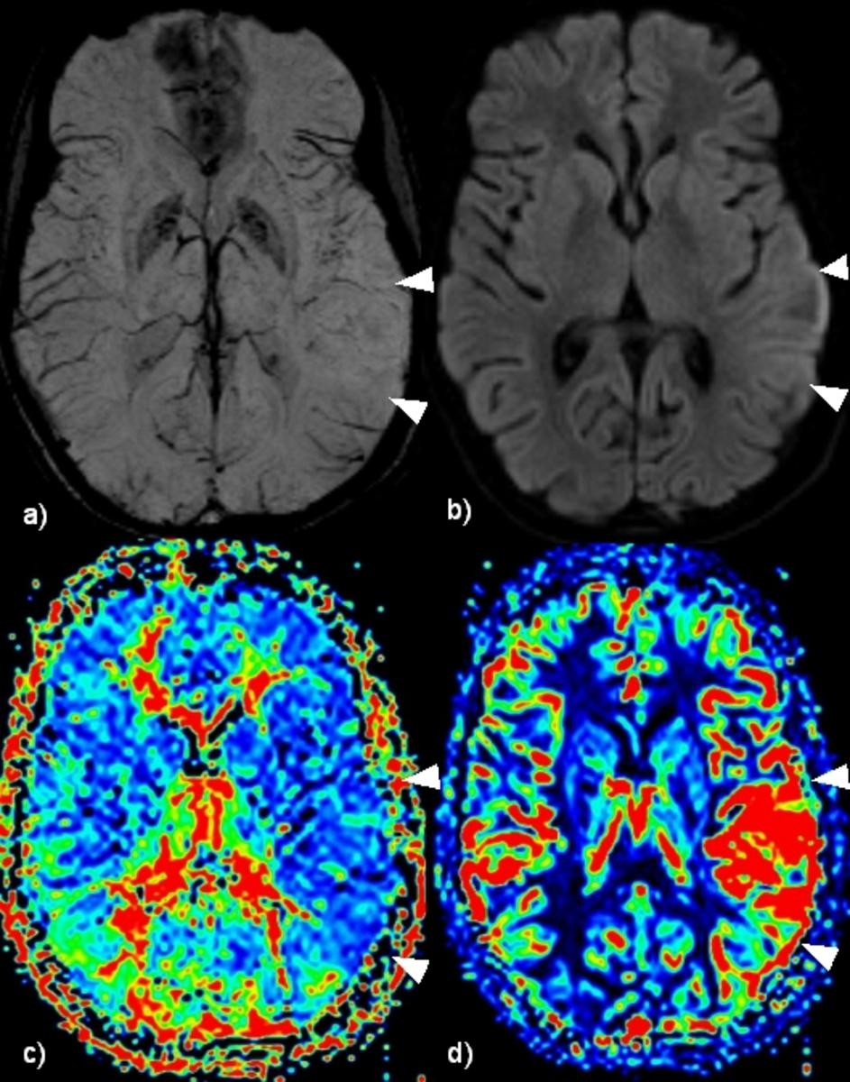 Fig. 1: years old female with MELAS syndrome and acute global aphasia.