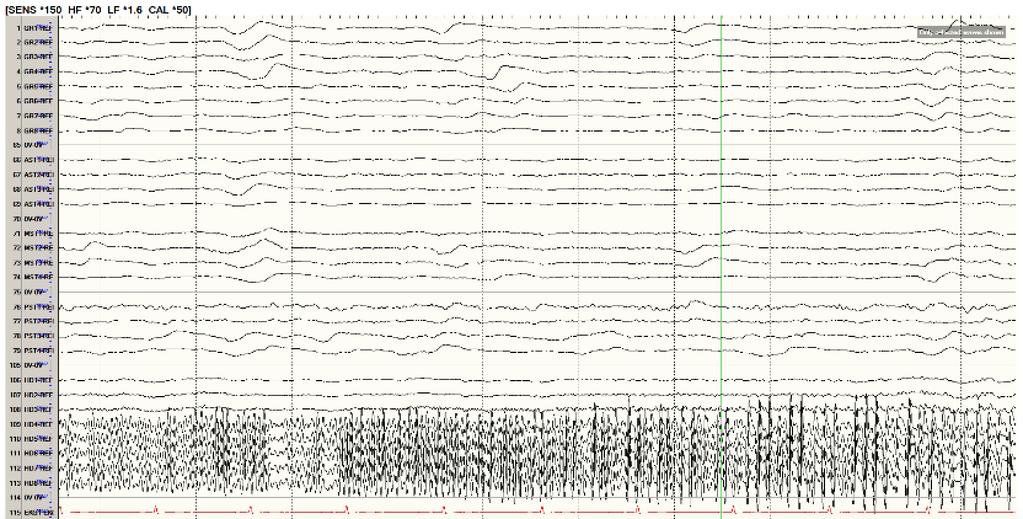 Intracranial monitoring: seizure activity isolated to HD4-8 7 seizures were