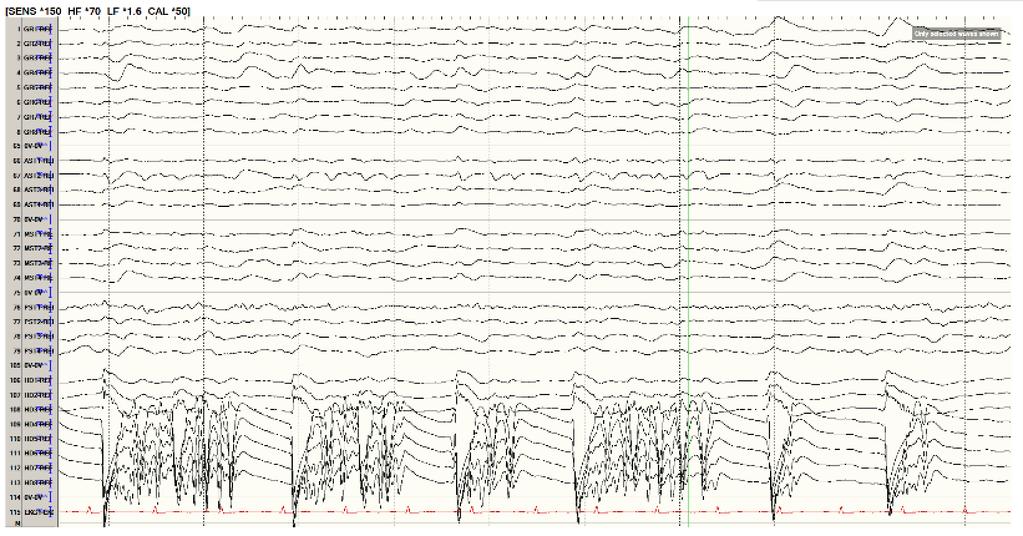 Intracranial monitoring: seizure activity isolated to HD4-8 7 seizures were