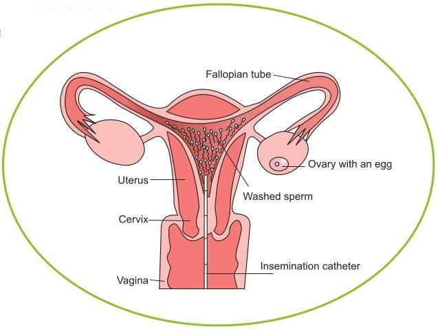 A. IUI is one of the procedures used to treat infertility.