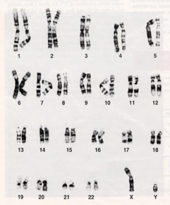 Recurrent implantation failure Genetic factors Parental karyotypes Incidence of chromosome abnormalities: Neonatal 0.2% Infertile couples 0.