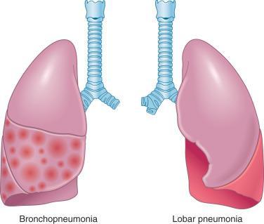 Community-Acquired Pneumonia Description Subjective Data Objective Data Treatment