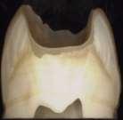 Enamel Superficial Dentin Middle Dentin Deep