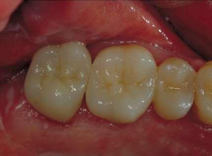 Cementation Resin Modified Glass Ionomer Cements Use Ceramic Primer prior to try-in Clean with ethanol after try-in Keep tooth slightly