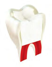 cavity prep T he final restoration in the same session is possible, whether a