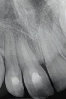 Bulk fill placement for a strong restoration Similar strength as dentin Biodentine cuts like dentin Similar stress absorption & flexural behavior as dentin - Similar mechanical properties as
