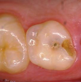 Initial clinical view of tooth #a for an 8-year-old patient.