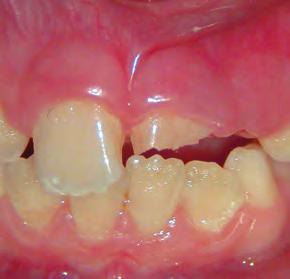 teeth Incisors are mostly concerned when it comes to crown fractures.