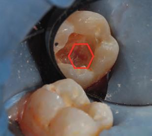 Complicated crown fracture with reversible pulpitis of tooth #9. Partial pulpotomy was ca bleeding was controlled.