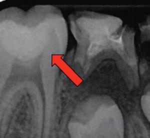 Radiograph after treatment.