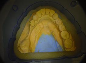4 Fig 1 Stone cast of a patient included in the study showing severe buccolingual bone resorption in the edentulous posterior mandible. [Au: Edit ok?