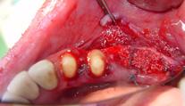 The sutures were initiated through the lingual full-thickness flap going to the buccal periosteum and then returning through the buccal periosteum and continuing in the lingual