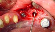 programmed implant position using a periodontal probe (Stoma Dental System).
