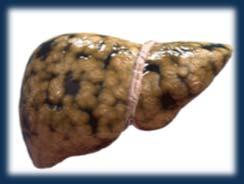 NAFLD Definition Evidence of hepatic steatosis (imaging or histology) and lack of secondary causes of fat accumulation (alcohol, steatogenic medication, monogenic