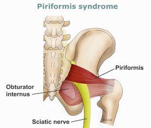 Ipsilateral Injuries. Piriformis sciatica! PI ilium = under active gluteal muscles.