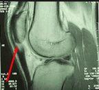 Ipsilateral injuries. CoM drop & excursion! Plantar heel pain!