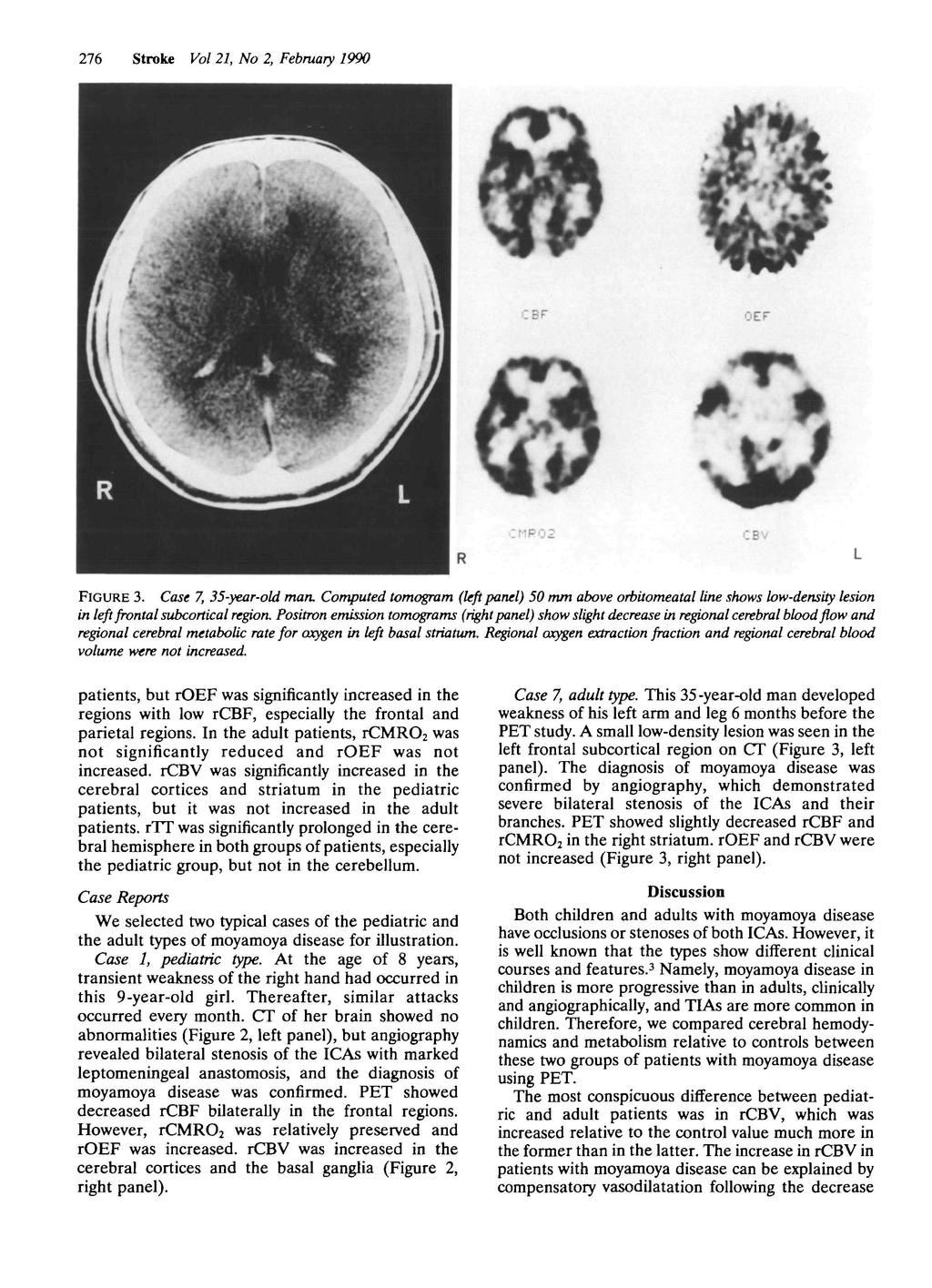 276 Stroke Vol 21, No 2, February 1990 OEF CMPOi FIGURE 3. Case 7, 35-year-old man.
