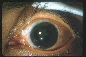 Sclerokeratoplasty was performed for therapeutic and diagnostic purposes.