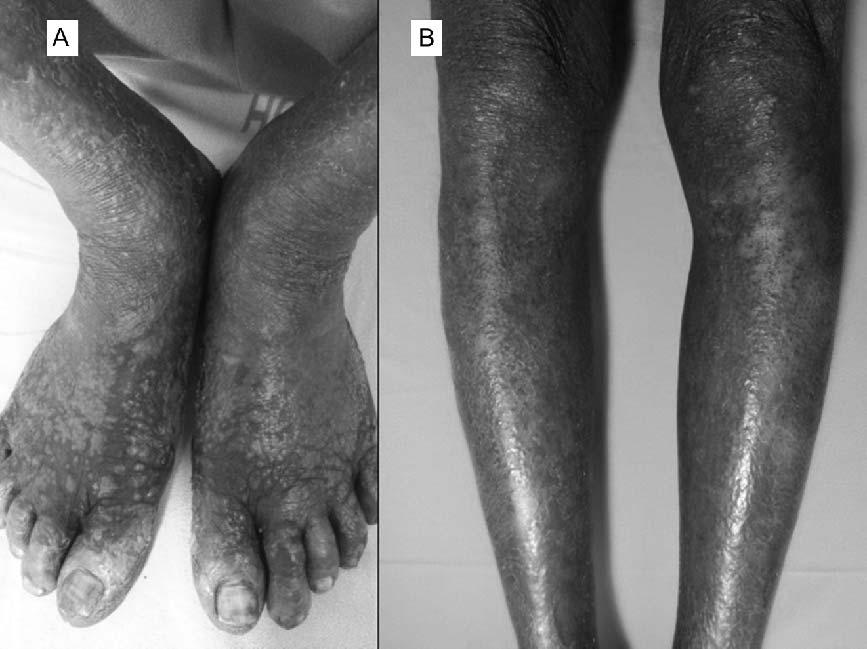 Uncommon presentations of leprosy 247 Figure 1. (A, B): (Case 1) Erythematous to hyper-pigmented scaly papules and plaques over extremities.